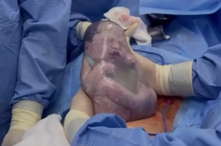bebê nascendo empelicado, sendo retirado da barriga envolto em saco amniótico