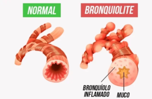 Dois desenhos de bronquíolos, comparando um saudável com outro inflamado, com muco.