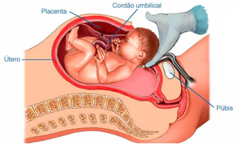 Parto cesárea visto do interior da barriga da mãe e localizando os órgãos. com a mão do médico posicionada atrás da cabeça do bebê em posição de nascimento